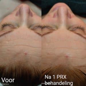 Voor en na een PRX-T33 behandeling