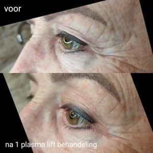 Plasmalift voor en na behandeling